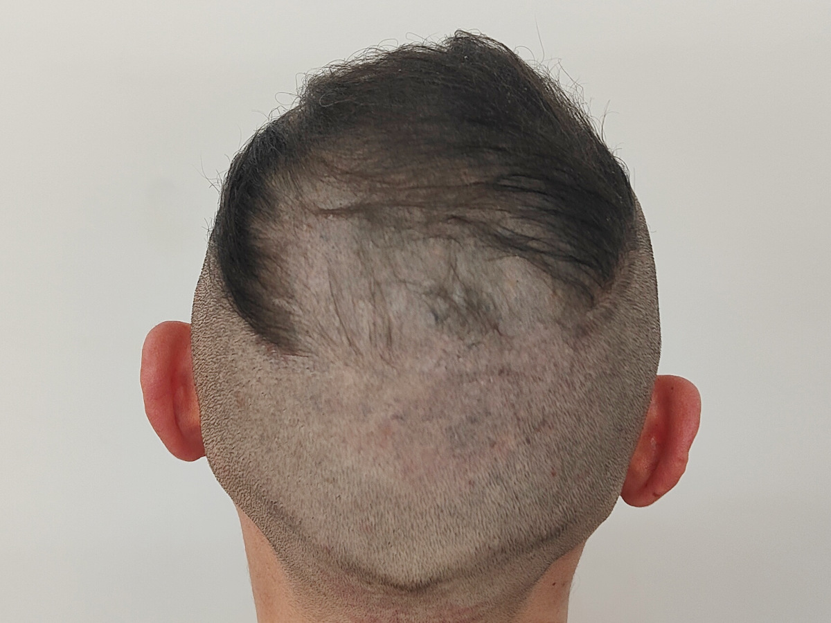 Trico Pigmentazione Pescara: soluzione estetica avanzata per il cuoio capelluto